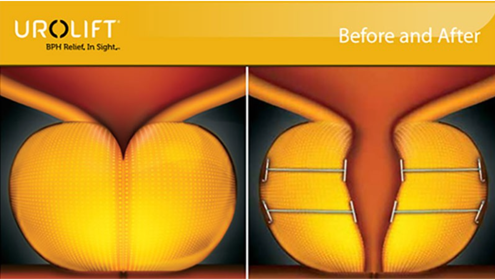 North Moon Lot de 7 capsules pour prostatite masculine.